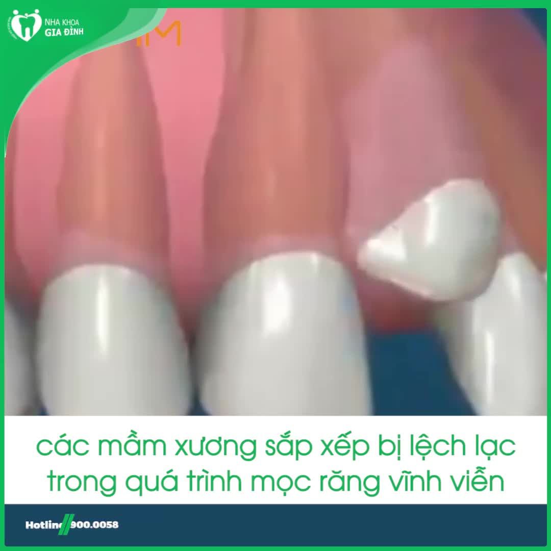GIẢI PHÁP NÀO CHO HÀM RĂNG KHẤP KHỂNH