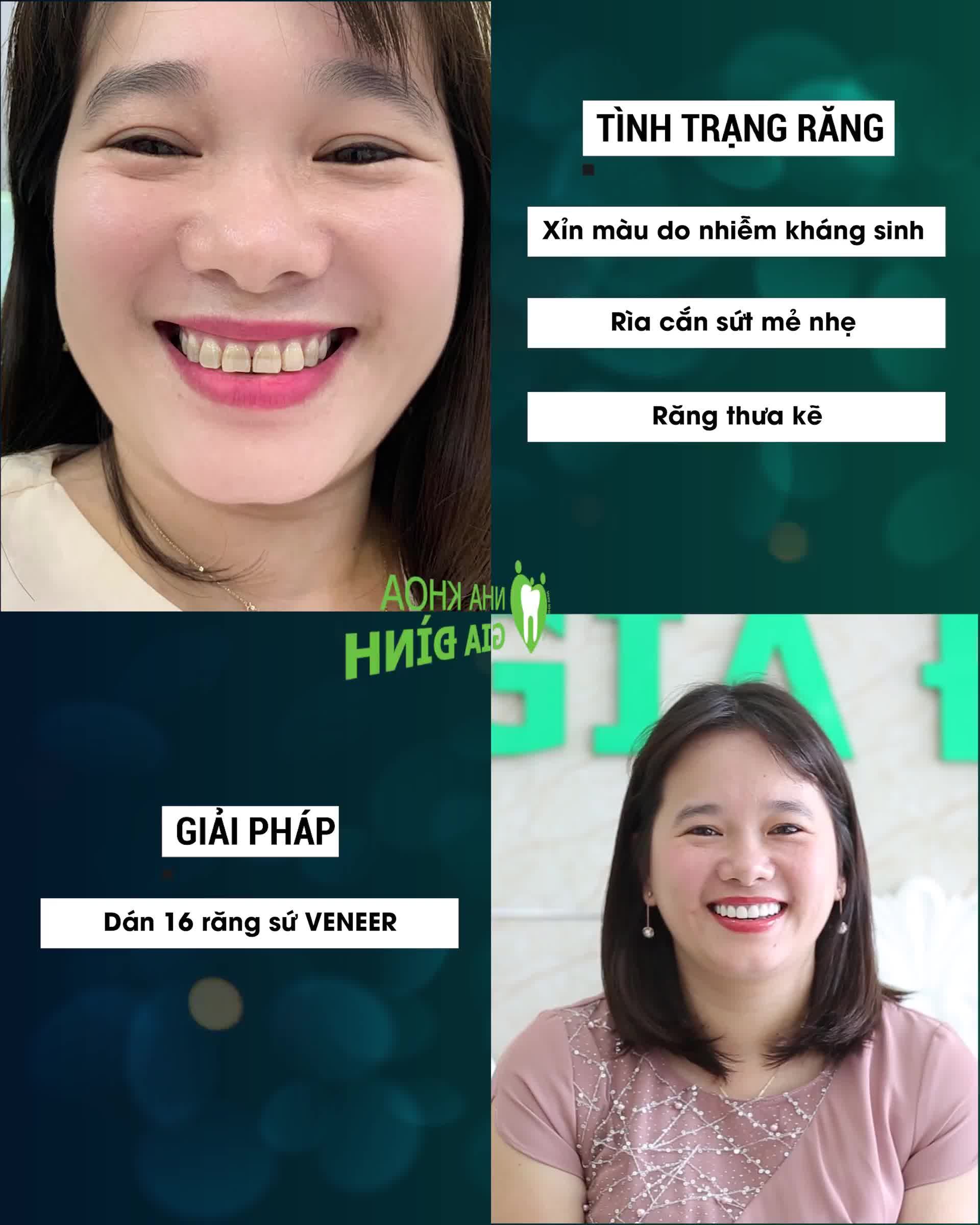 TOP 5 THAY ĐỔI NGOẠN MỤC NHỜ DÁN SỨ VENEER