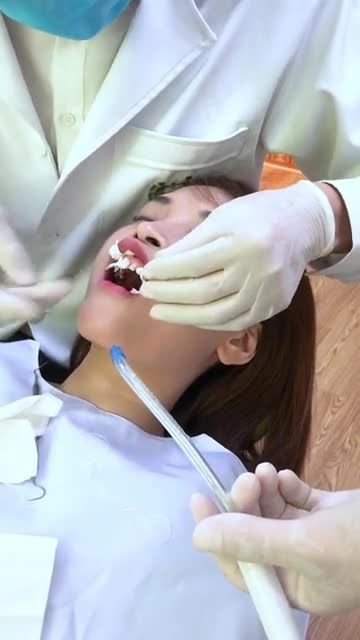 CASE KHÁCH HÀNG DÁN 20 VENEER kết hợp làm 4 CHỤP SỨ - Chị Phương Anh