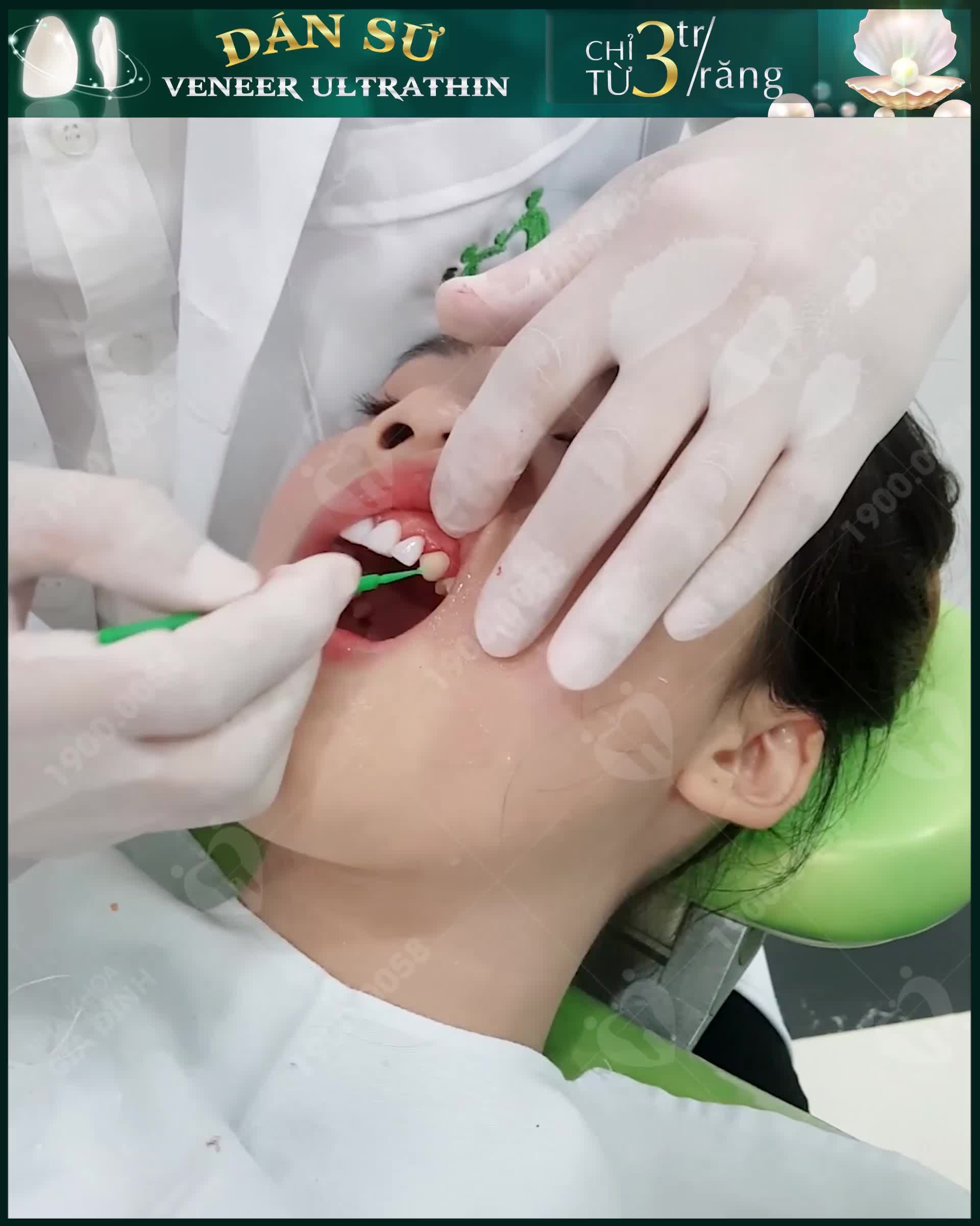 XUẤT SẮC VỚI DÁN SỨ VENEER SIÊU MỎNG TẠI NHA KHOA GIA ĐÌNH