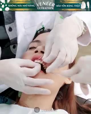 DÁN SỨ VENEER 100% KHÔNG MÀI NHỎ, BẢO TỒN RĂNG THẬT