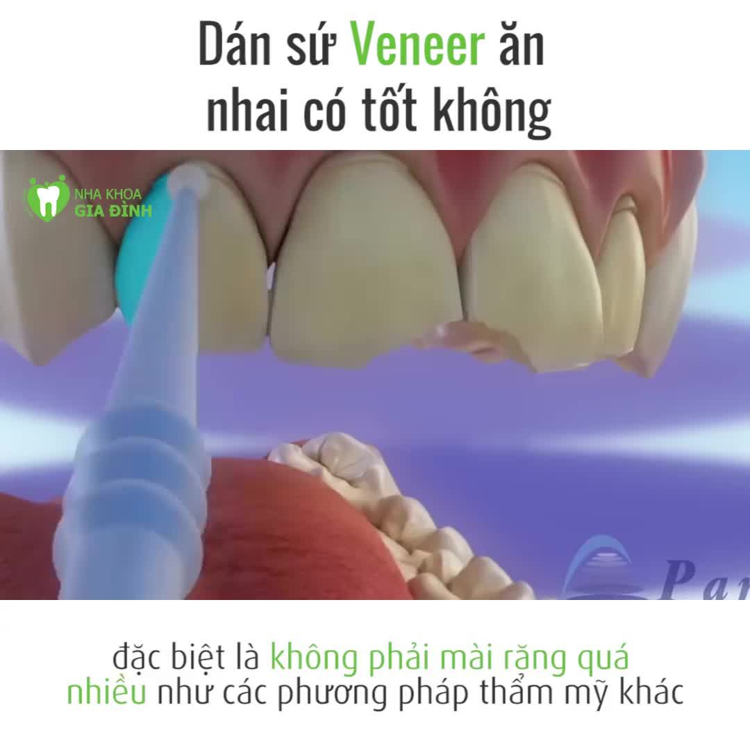 DÁN SỨ VENEER ĂN NHAI CÓ TỐT KHÔNG