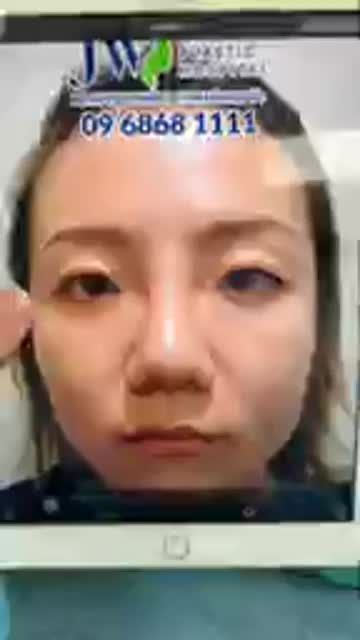 GIẢI CỨU MŨI HỎNG VÌ TIÊM FILLER CHO KHÁCH HÀNG ĐẾN TỪ SINGAPORE
