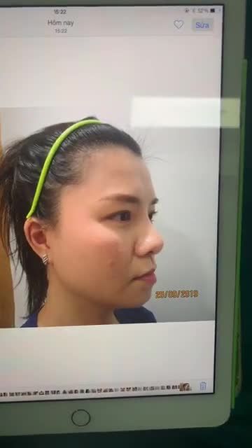 GIẢI CỨU KHẨN CẤP MŨI CO RÚT LỘ SÓNG TẠI BỆNH VIỆN JW