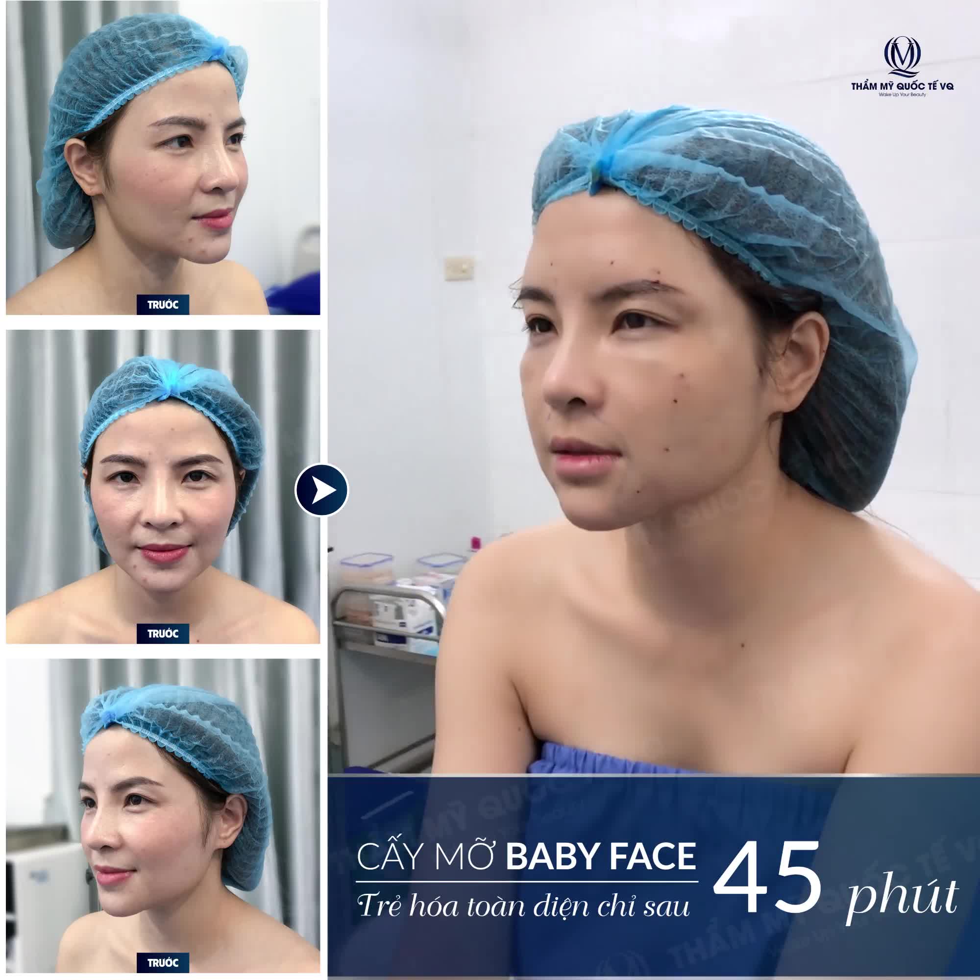 Hồi sinh nhan sắc với giải pháp cấy mỡ BABY FACE