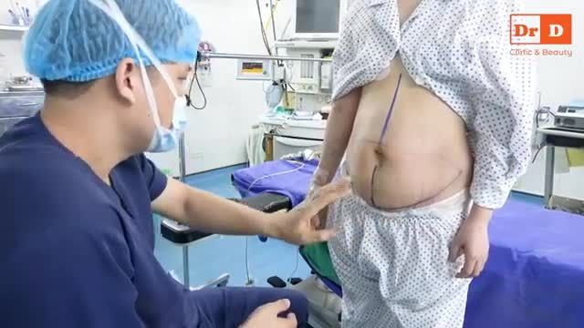 Hút mỡ tạo hình thành bụng