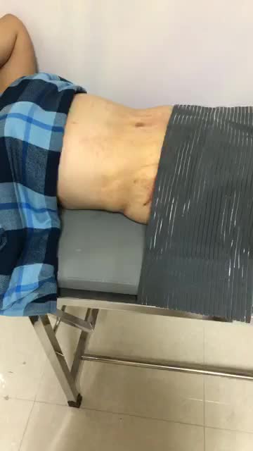 Kết quả MỸ MÃN sau phẫu thuật Tạo hình thành bụng chuyển rốn của khách hàng nhà Dr Quang Đức