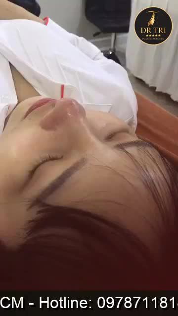 Kết quả sau phẫu thuật tạo hình mũi A_Shape 10 ngày, dáng mũi tự nhiên theo yêu cầu của chị khách hàng dễ thương!