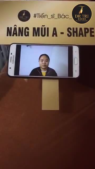 Kết quả sau phẫu thuật tạo hình mũi A_Shape , tạo_hình_mí_trên của khách hàng sau 2 tuần tái khám!