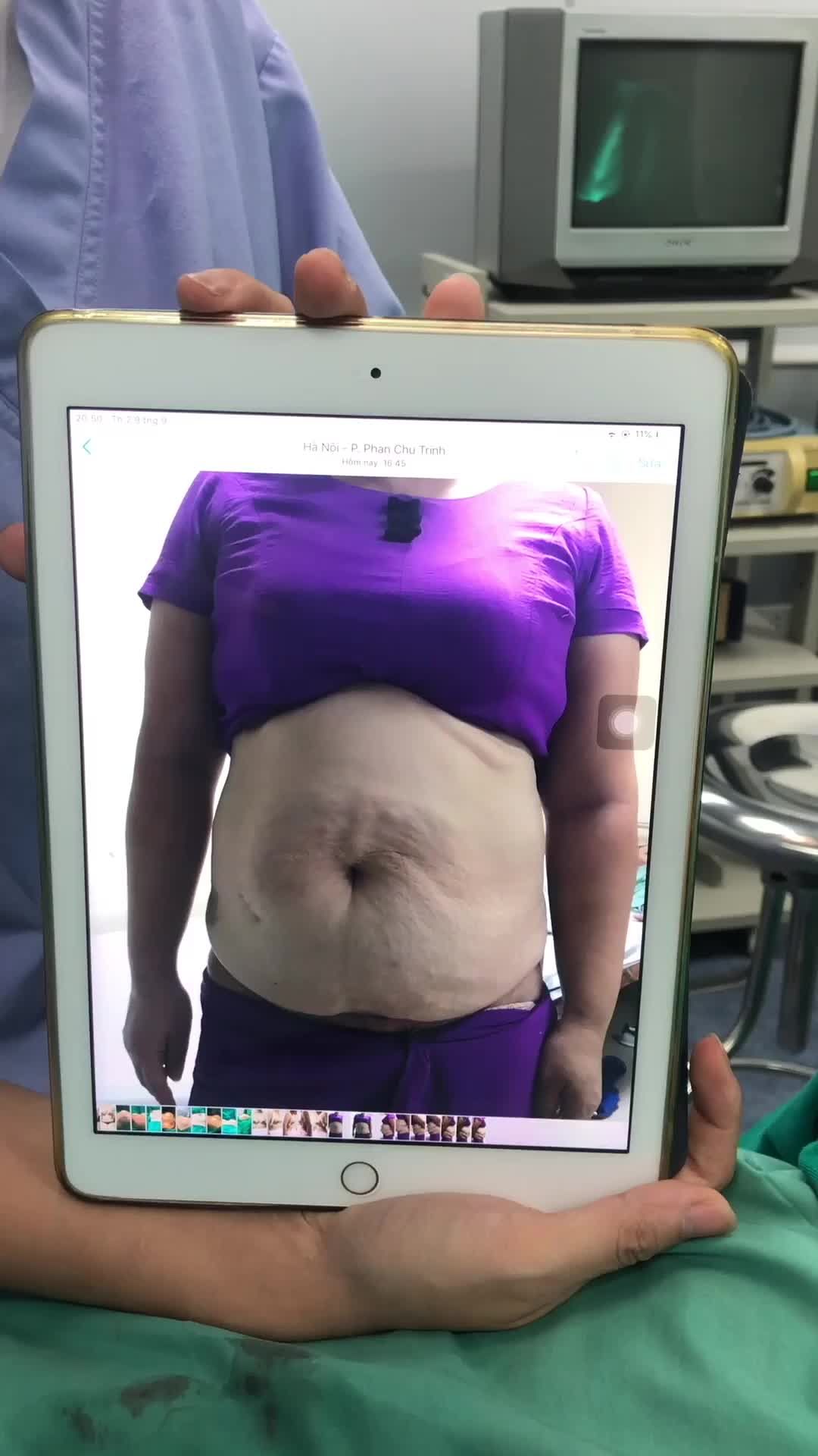 Kết thúc ca PT với 3,8l mỡ và gần 40centi da + m.ỡ thừa