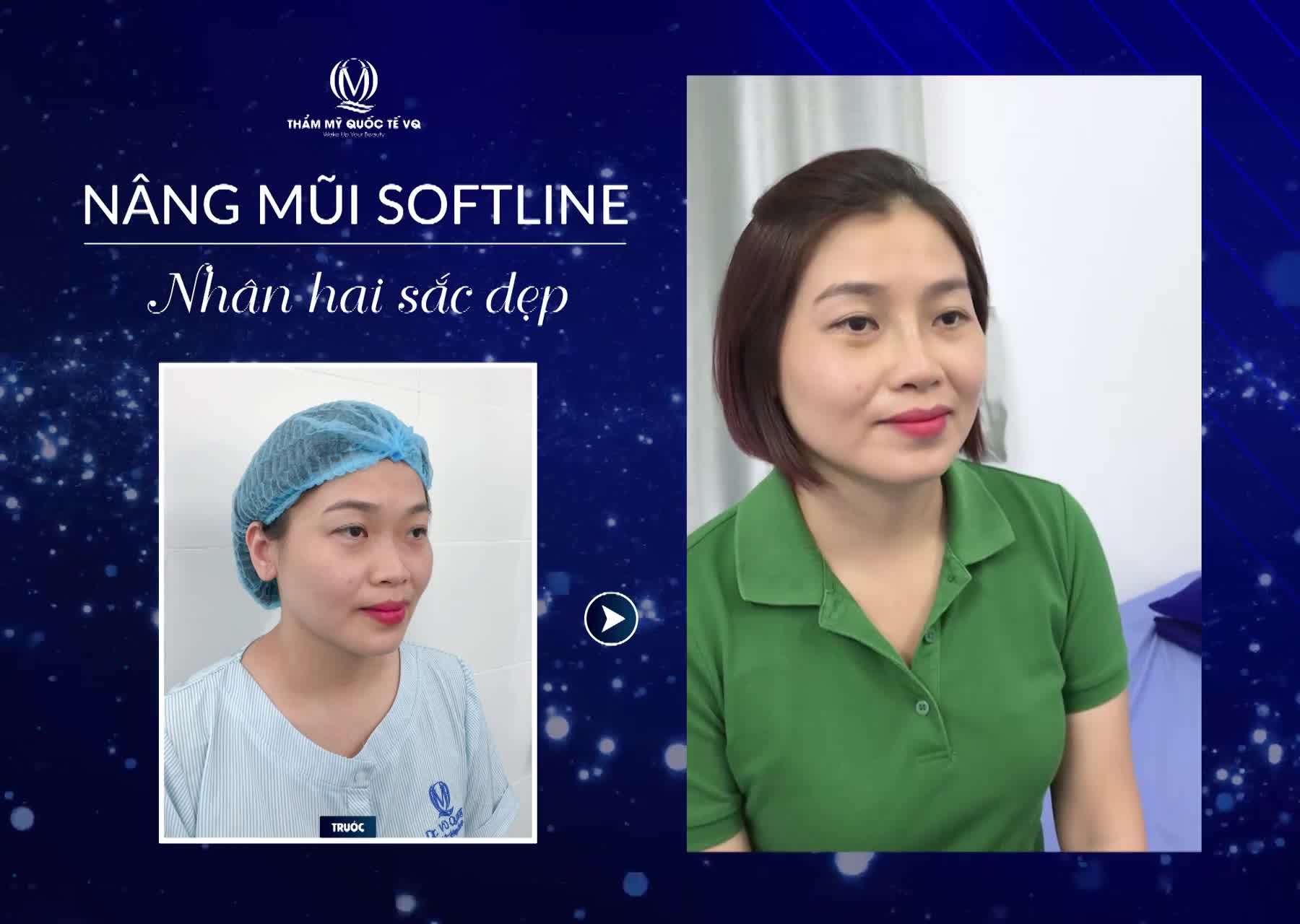 KHÁCH HÀNG SAU 12 NGÀY NÂNG MŨI SOFTLINE