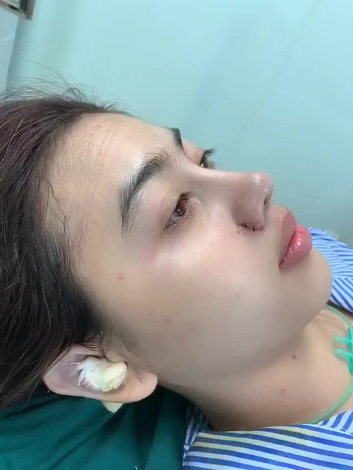 Khách làm Combo nâng mũi cấu trúc + Thu đầu mũi, cuốn cánh mũi