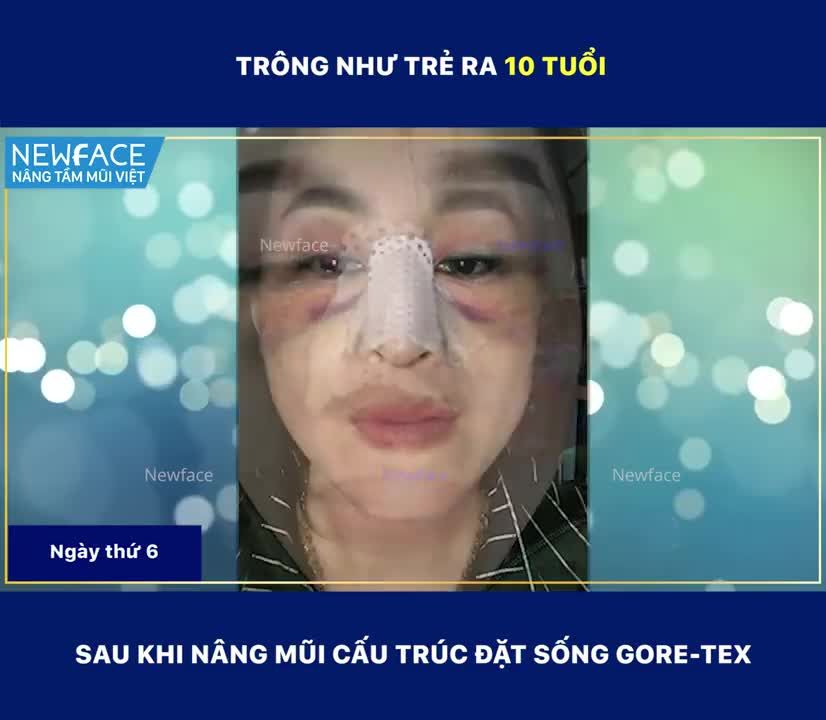 KHÔNG UỔNG CÔNG TỪ SINGAPORE VỀ, CHỊ ẤY ĐÃ SỞ HỮU DÁNG MŨI ĐẸP MÀ BẤY LÂU AO ƯỚC