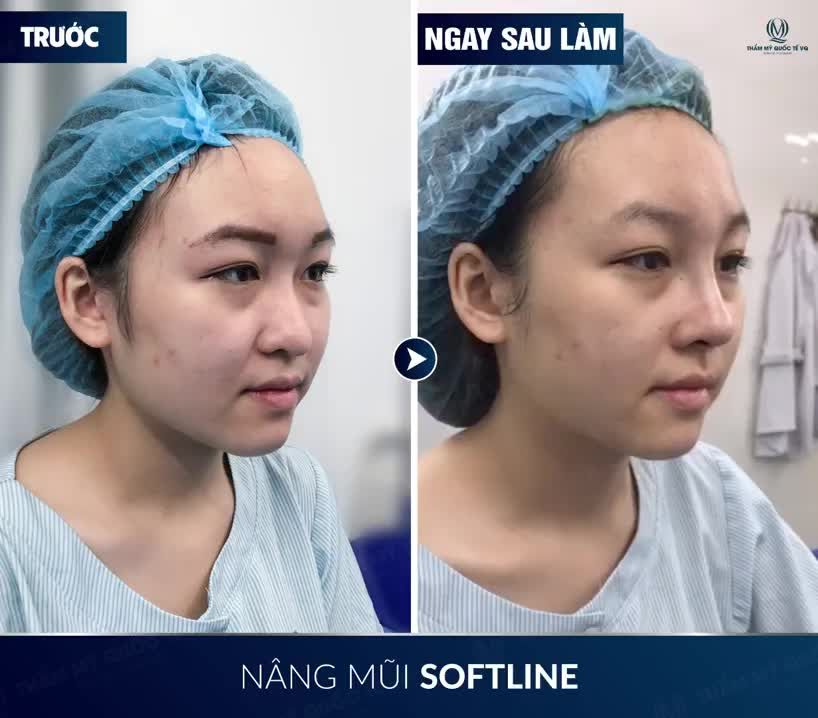 MŨI CAO THANH TÚ CHỈ SAU 45 PHÚT