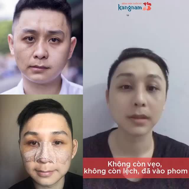 Kết quả sau 2 tuần Nâng mũi cấu trúc 4D siêu âm nè cả nhà