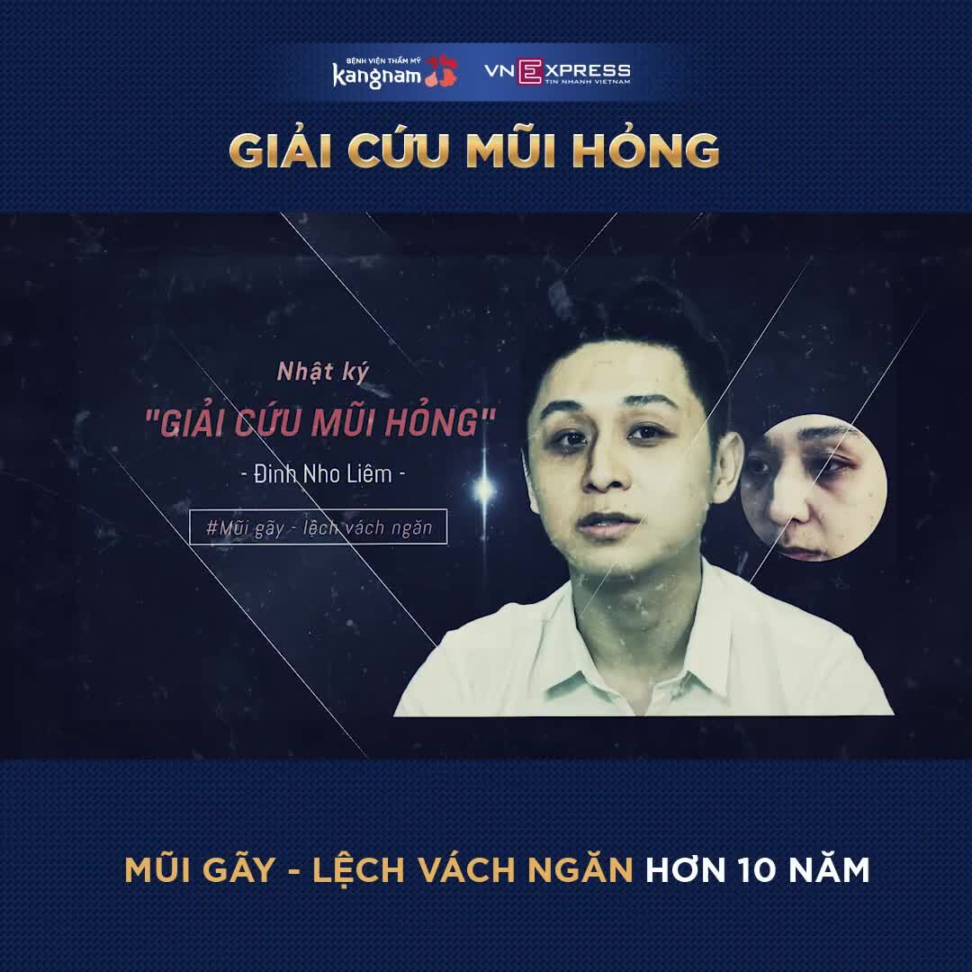 MŨI GÃY, CONG VẸO sau tai nạn cần can thiệp chỉnh xương