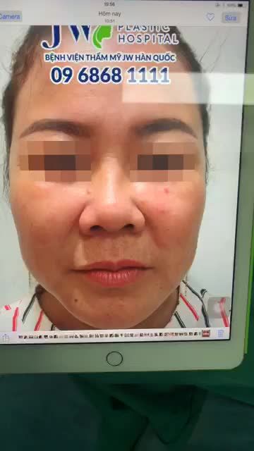 60 PHÚT SỞ HỮU NGAY SIÊU DÁNG MŨI S LINE - NÂNG MŨI NÂNG LUÔN TÀI LỘC