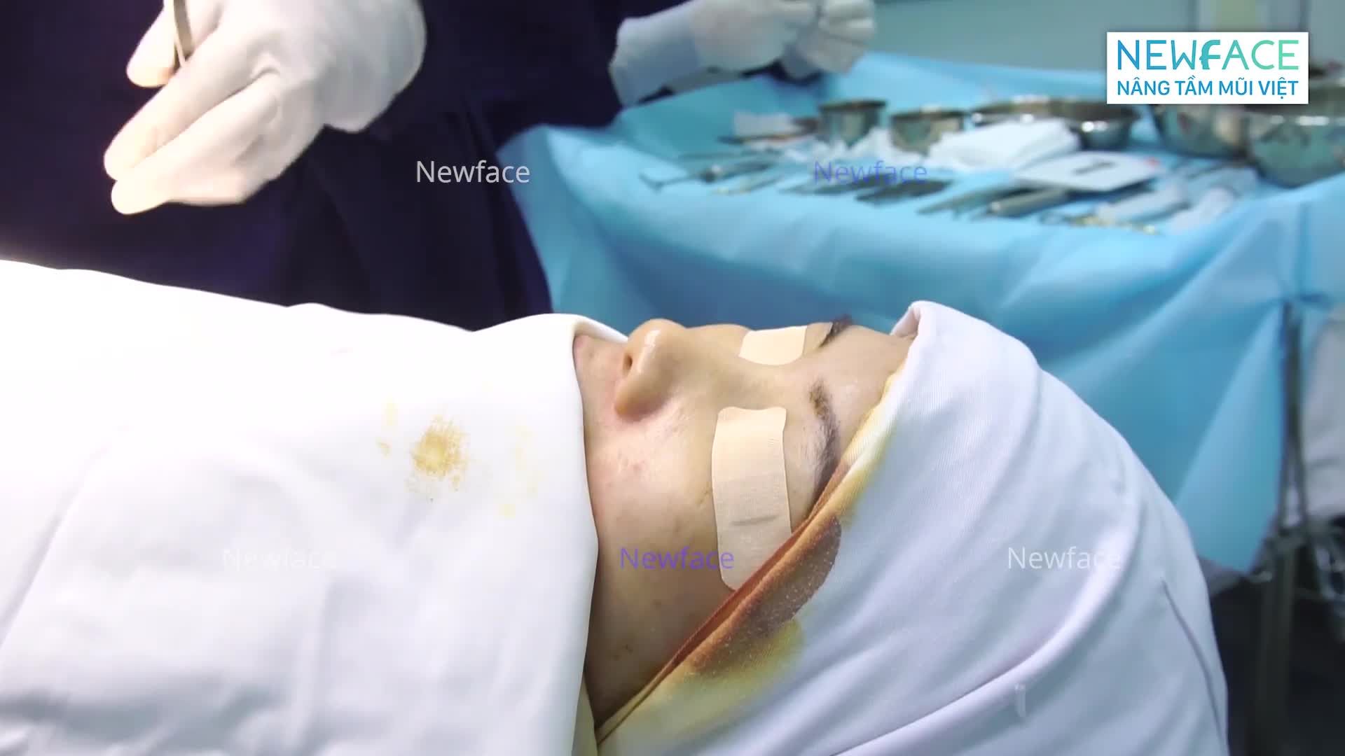 NÂNG MŨI SỤN SƯỜN - ĐẸP XUẤT SẮC NGAY SAU PHẪU THUẬT
