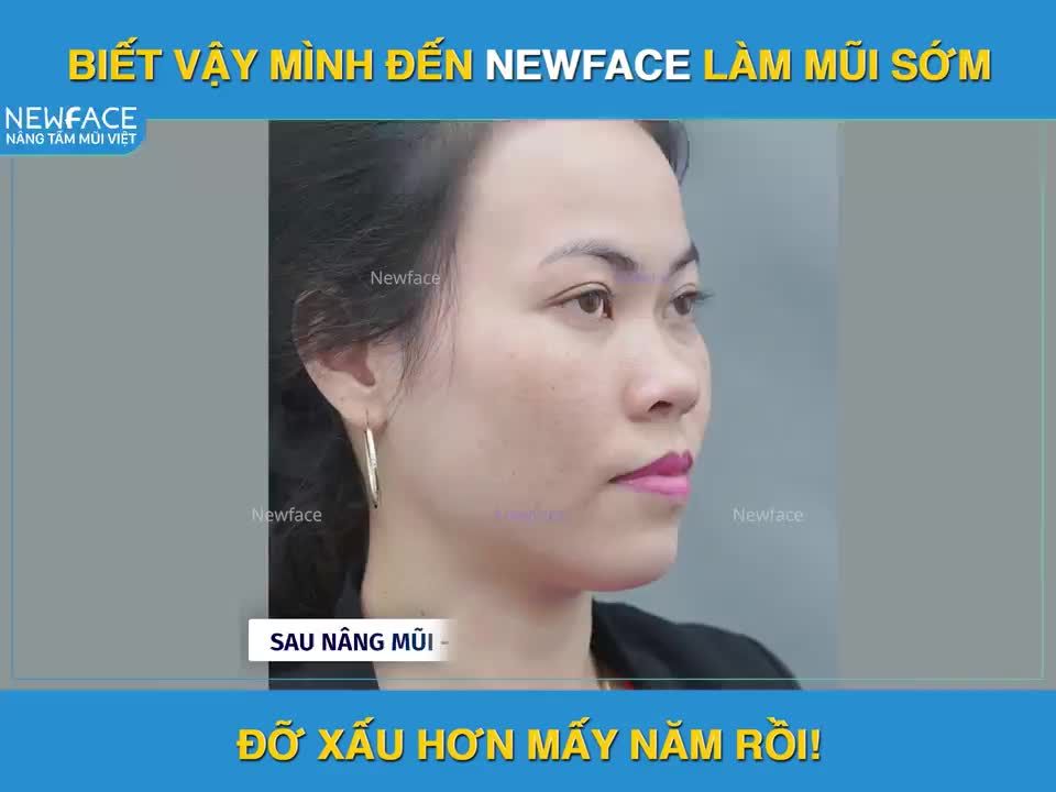 NÂNG MŨI SỤN SƯỜN SAU GẦN 2 THÁNG - VỚI EM MỌI THỨ ĐỀU HOÀN HẢO
