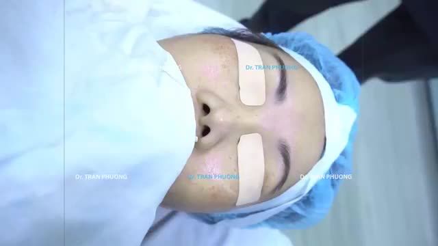 Nâng mũi sụn sườn tự thân sửa mũi đã đặt silicone trước đây