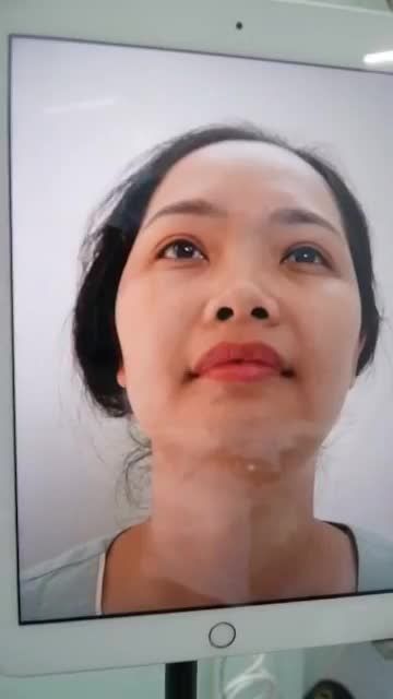 NÂNG MŨI THAY ĐỔI CẢ KHUÔN MẶT - 45 PHÚT SỞ HỮU NGAY MŨI ĐẸP