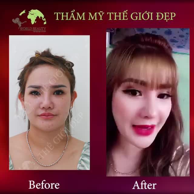 Nâng mũi xong liệu có GIÀ hơn?