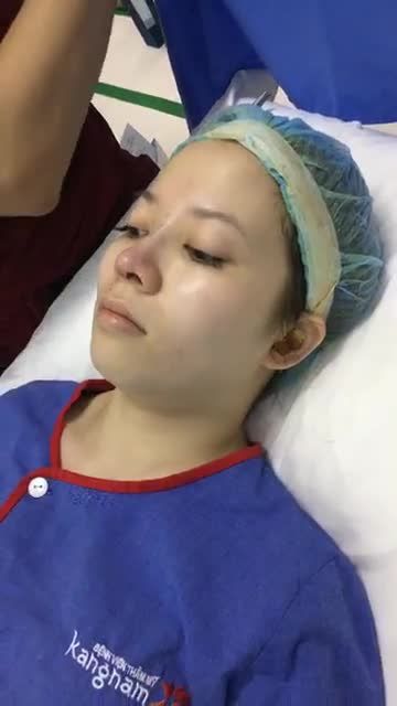 Quá trình nẹp mũi sau khi nâng mũi cấu trúc 4D tại bệnh viện thẩm mỹ kangnam tại Hà Nội
