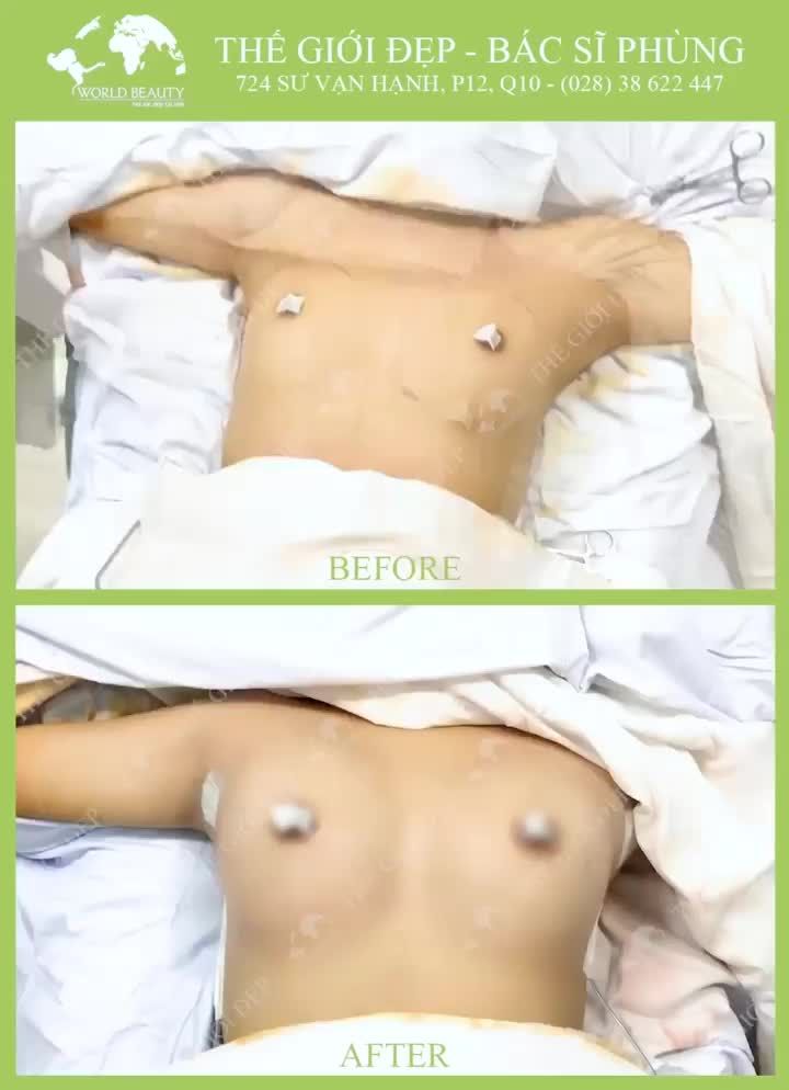 Giải pháp nào để có được NGỰC ĐẪYĐÀ?