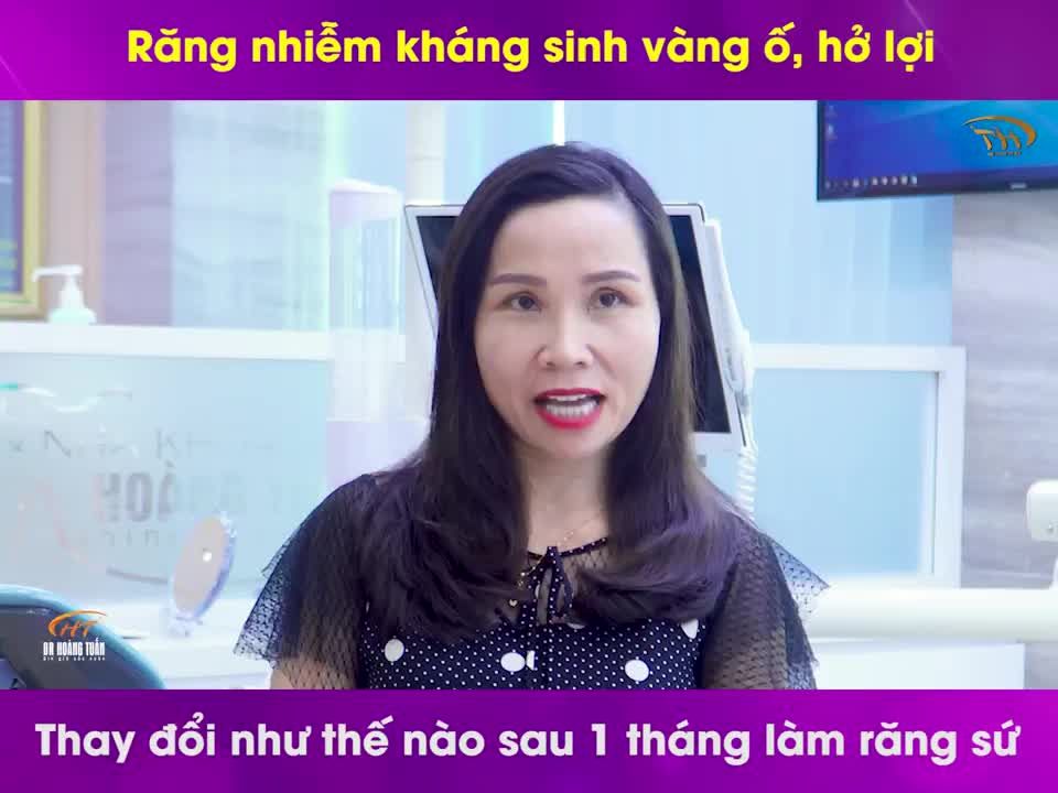 Răng nhiễm kháng sinh vàng ố, hở lợi