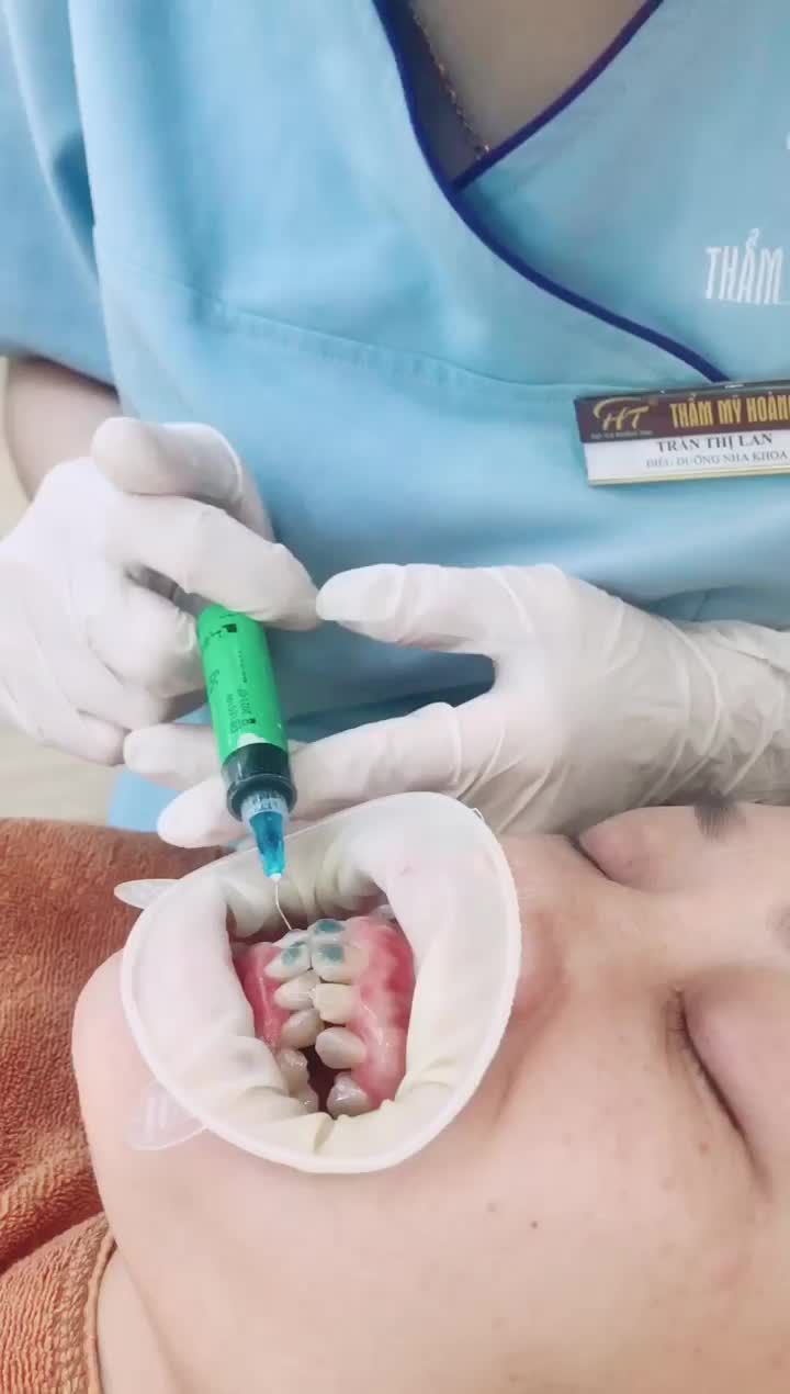 1 case chỉnh nha cho hàm răng hô (vẩu) khấp khểnh chuẩn bị gắn mắc cài