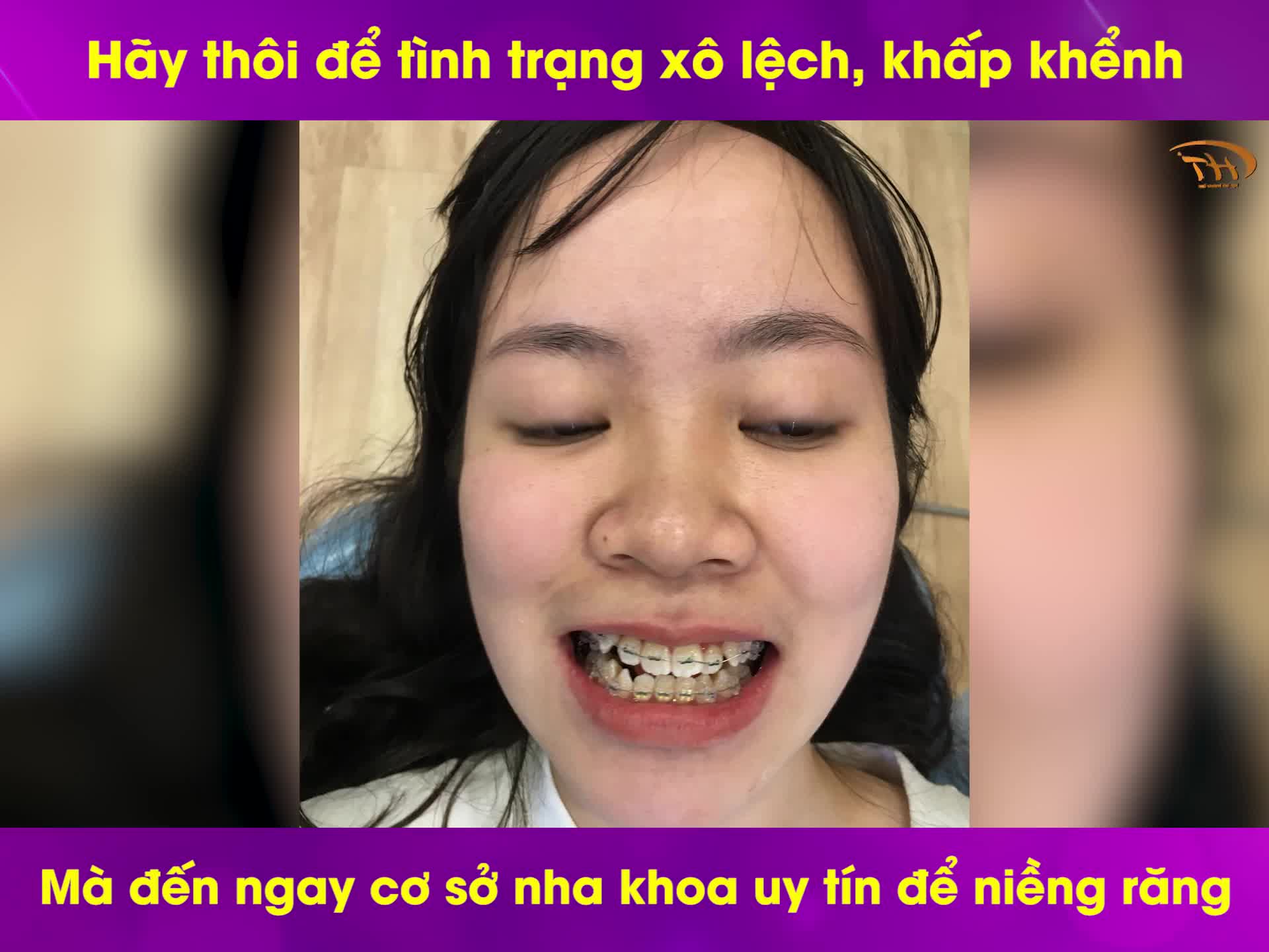 Hãy thôi để tình trạng xô lệch, khấp khểnh mà hãy đến ngay cơ sở nha khoa uy tín để niềng răng