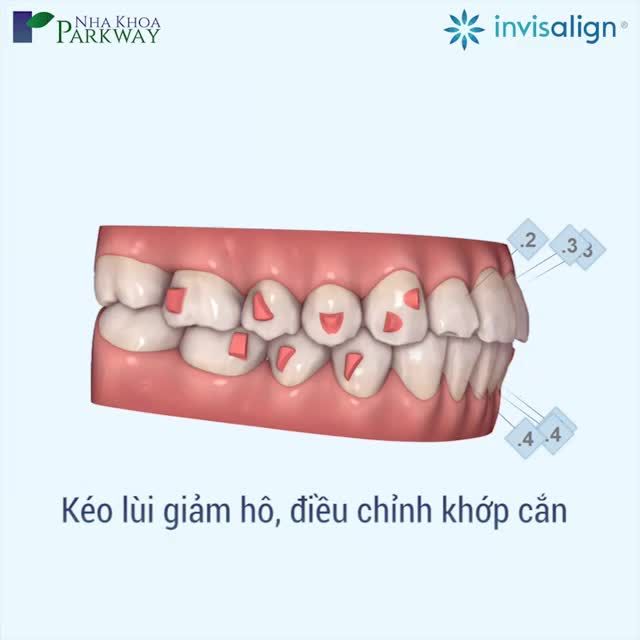 INVISALIGN SERIES | THAY ĐỔI TUYỆT VỜI CÙNG INVISALIGN