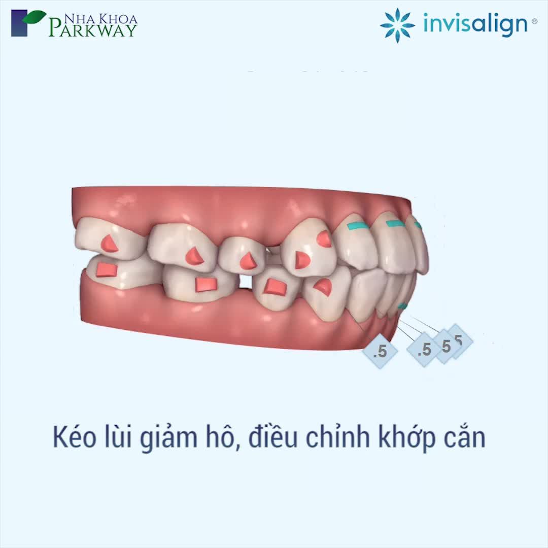 PHẦN 13: INVISALIGN, PHÉP MÀU “HÔ BIẾN" RĂNG HÔ TRỞ NÊN ĐỀU ĐẸP
