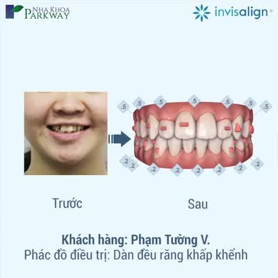 PHẦN 12: RĂNG HẾT KHẤP KHỂNH SAU 1 NĂM VỚI INVISALIGN