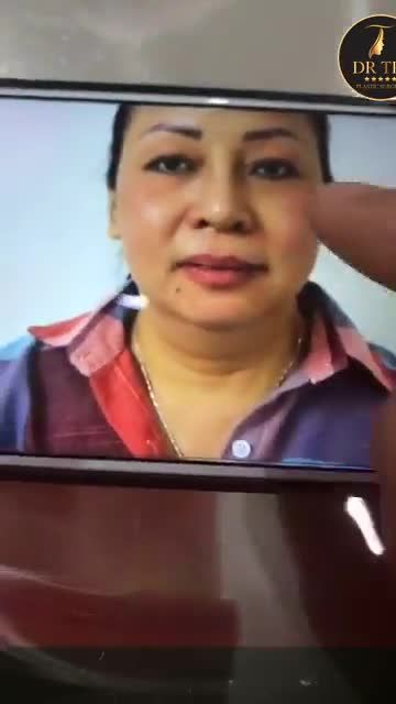 Phẫu thuật tạo hình mũi A Shape từ chiếc mũi to bè thành mũi nhỏ