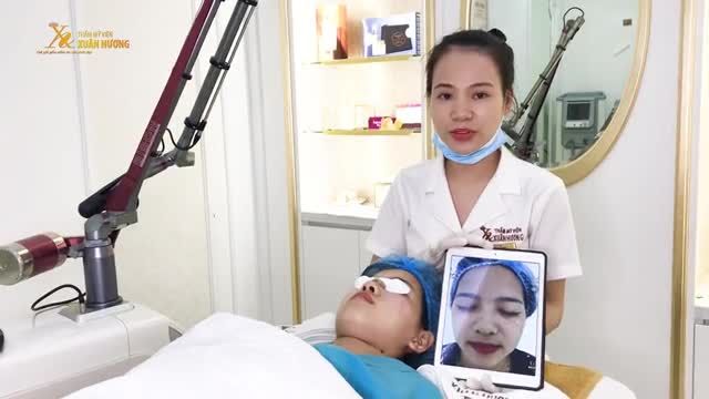 SẠCH HẾT TÀN NHANG BẨM SINH CHỈ SAU 1 LẦN ĐIỀU TRỊ NỮ KHÁCH HÀNG HÀI LÒNG QUAY TRỞ LAI TIẾP TỤC TRỊ LIỆU NÁM CÔNG NGHỆ LUCID Q-PTP