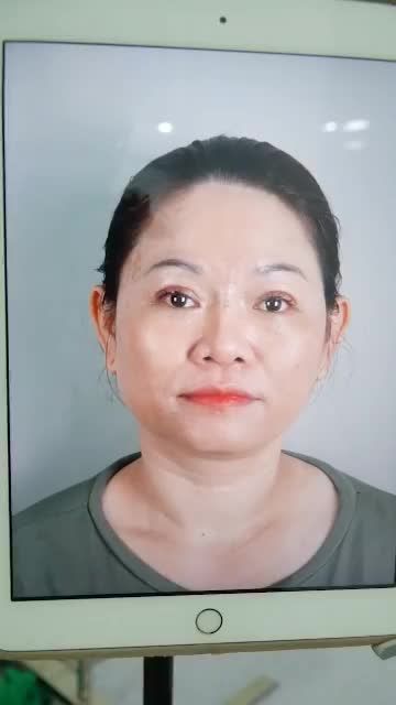 SỬA LẠI CA MŨI BỊ HỎNG CHO KHÁCH SAU KHI NÂNG NƠI KHÔNG UY TÍN DẪN ĐẾN LỘ SÓNG, BÓNG ĐỎ ĐẦU MŨI