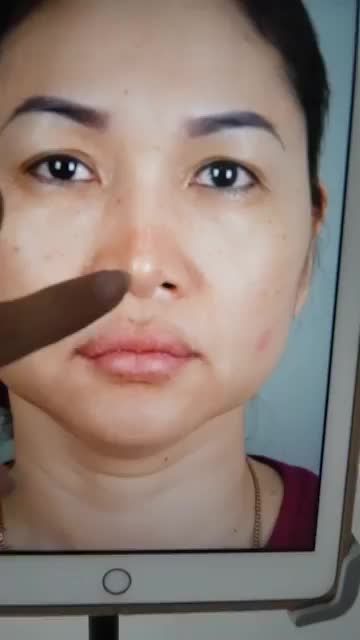 SỬA MŨI HỎNG CHO KHÁCH TỪNG NÂNG MŨI Ở ĐỊA CHỈ KHÁC