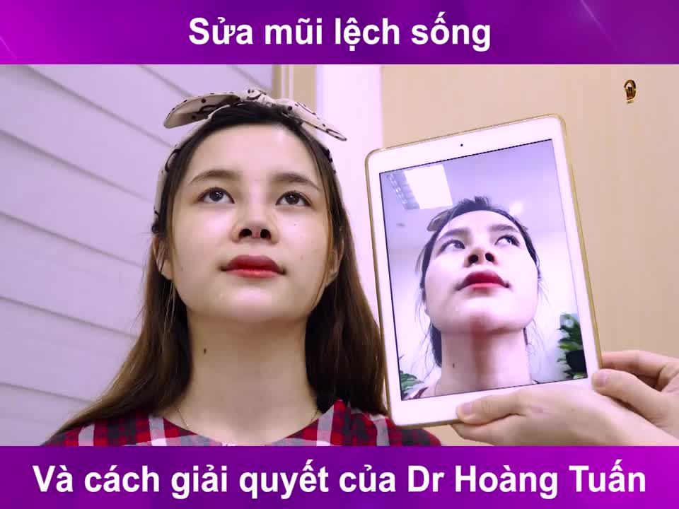 Sửa mũi lệch sống và cách giải quyết của bác sĩ Hoàng Tuấn