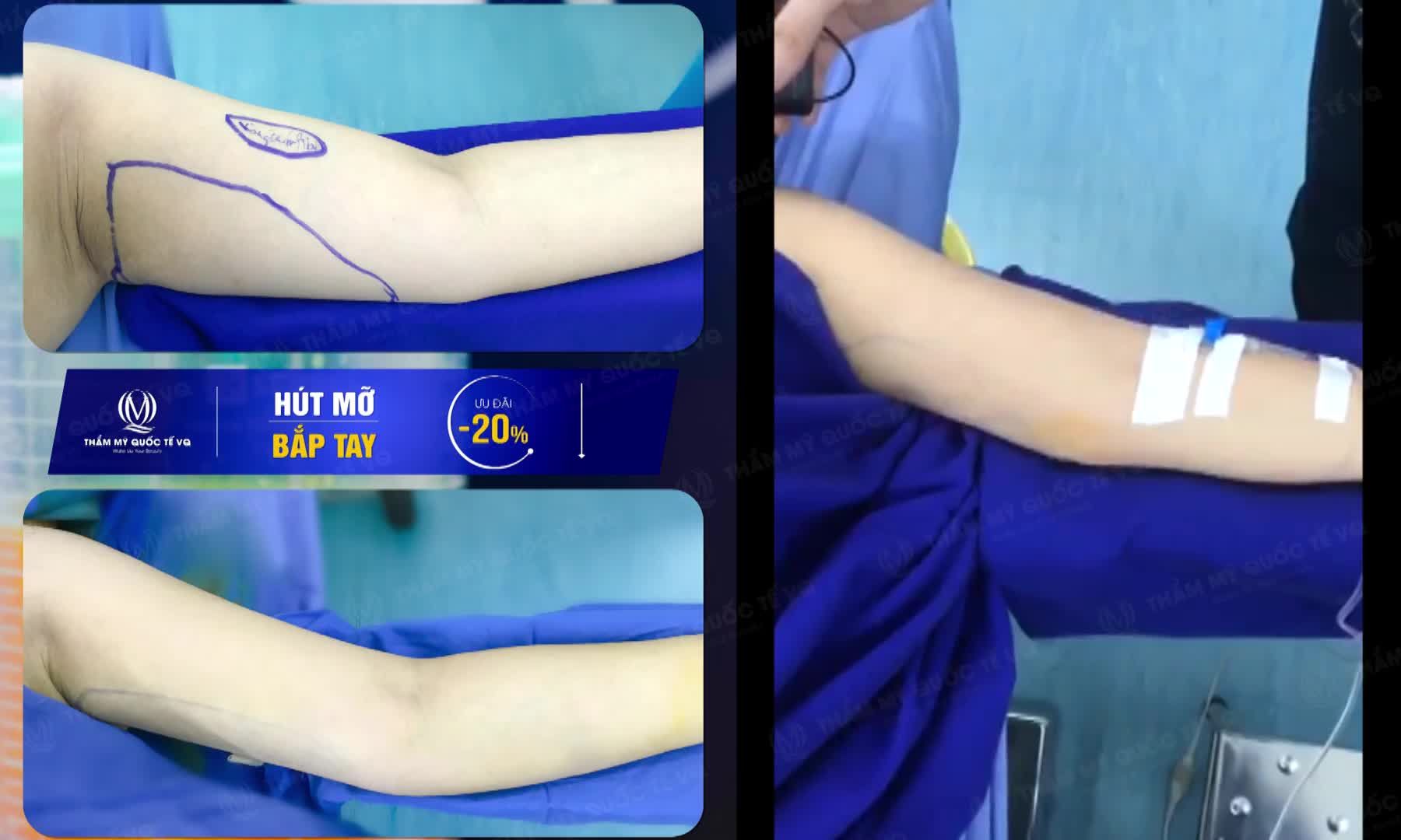 TAY TO ĐÂU CẦN PHẢI LO. VÌ GIỜ ĐÃ CÓ HÚT MỠ BẮP TAY BẰNG CÔNG NGHỆ BODY_JET
