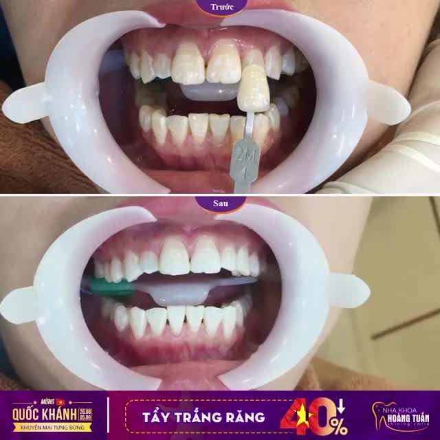 TẨY TRẮNG RĂNG GIẢM CHỈ CÒN 1.5 TRIỆU