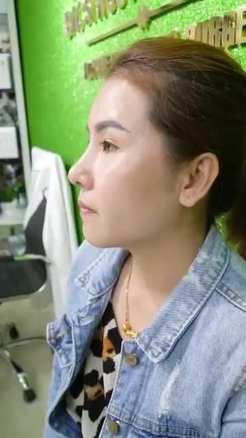 " THẬT BẤT NGỜ!" – KẾT QUẢ SAU 14 NGÀY NÂNG MŨI CẤU TRÚC SỬA LẠI TẠI DR HOẠT