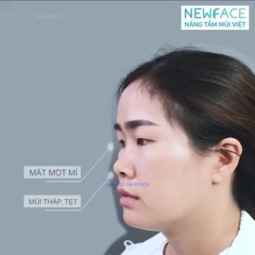 CHỈ NÂNG MŨI VÀ CẮT MÍ - THAY ĐỔI HOÀN TOÀN DIỆN MẠO?