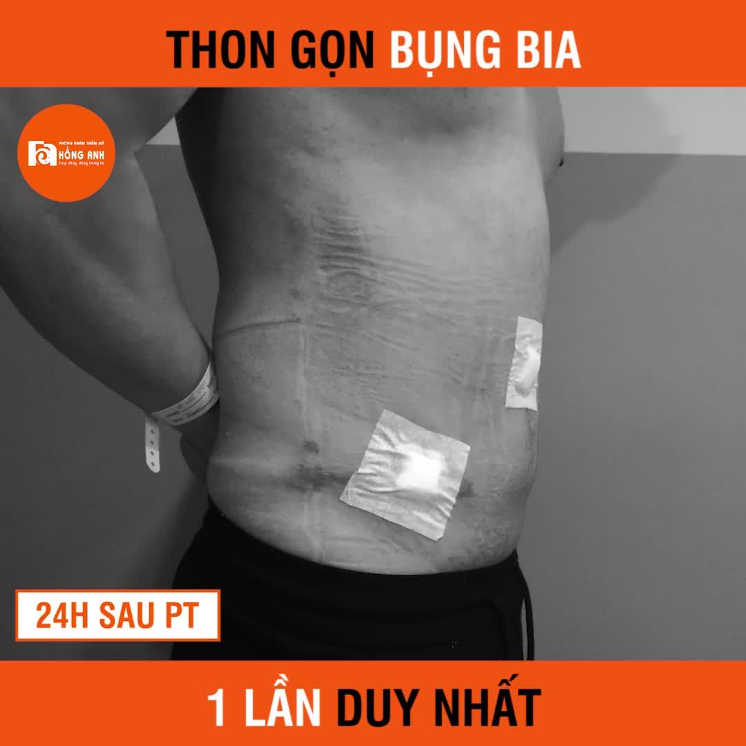 THON GỌN BỤNG BIA. Chỉ 1 lần, loại bỏ 100% mỡ thừa, da dư