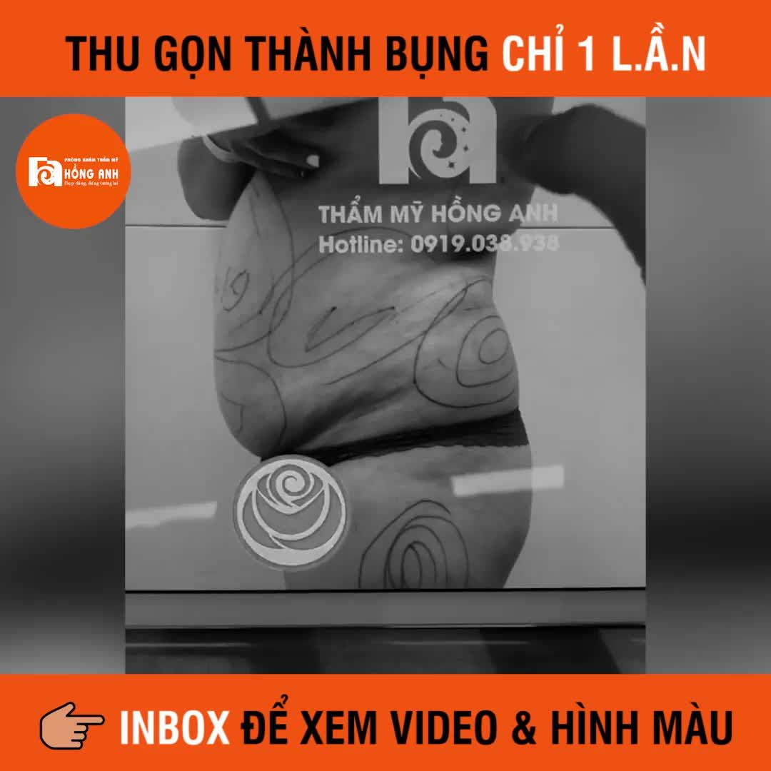 THU GỌN THÀNH BỤNG - THẨM MỸ VÒNG 2 TOÀN DIỆN