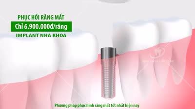 NHỨC NHỐI VÌ ᗰẤT RĂNG 
 TRỒNG RĂNG IMPLANT CHỈ VỚI 7.000.000đ/RĂNG