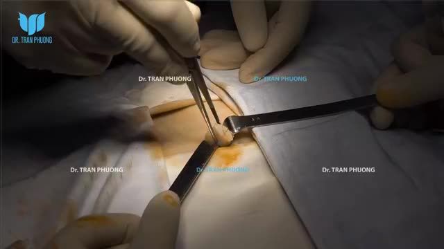 Toàn cảnh ca phẫu thuật  nâng mũi sụn sườn tự thân
