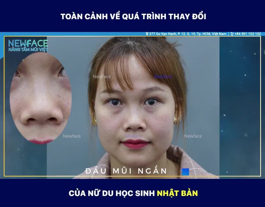 Toàn cảnh quá trình thay đổi của bạn Du học sinh Nhật Bản! Xem ngay để biết nâng mũi đã giúp bạn ấy thay đổi như thế nào nhé!