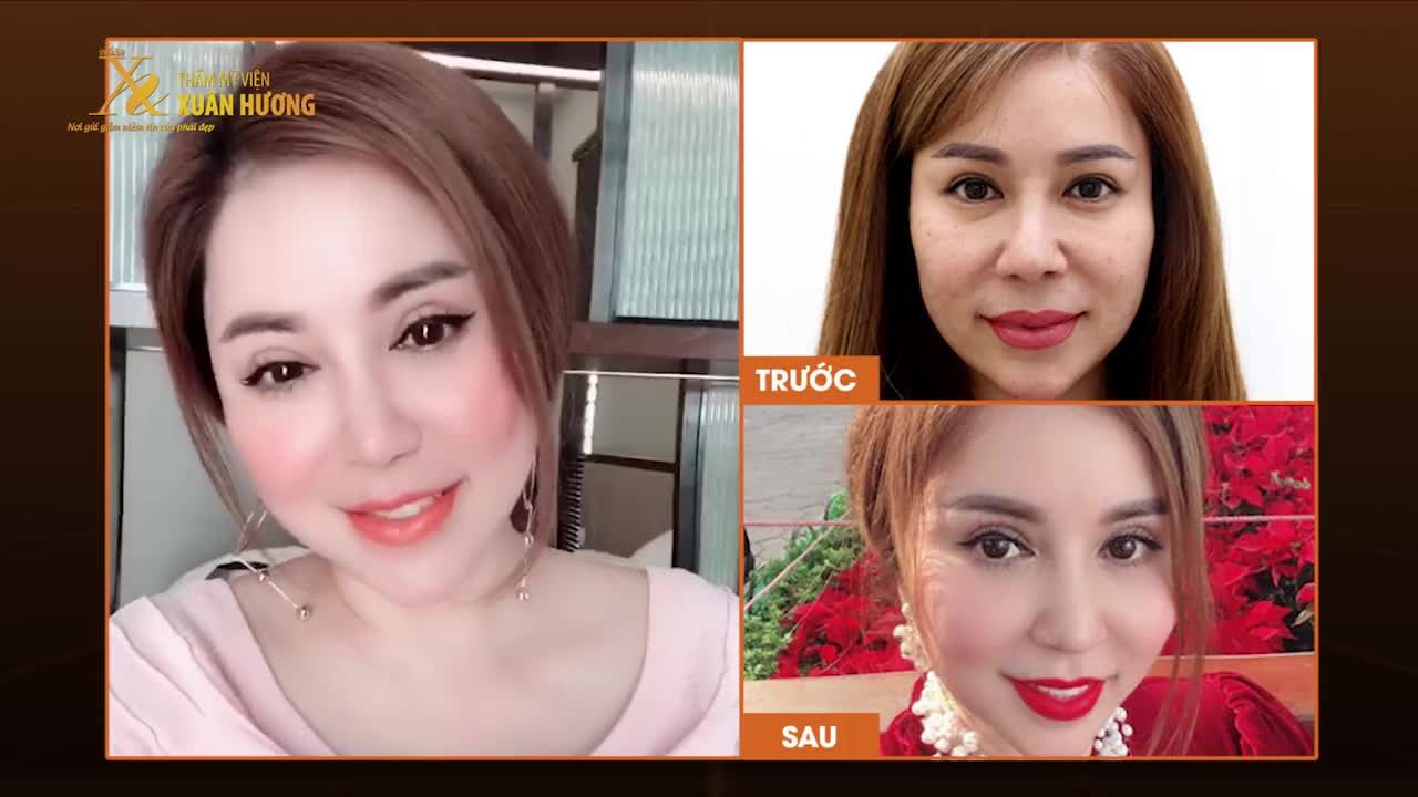 TRẺ RA 10 TUỔI NHỜ COMBO CẮT MÍ TRÊN + DƯỚI | GIẢM 15%