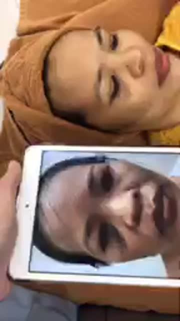 LASER REVLITE - SẠCH BAY VẾT BỚT OTA BẨM SINH!